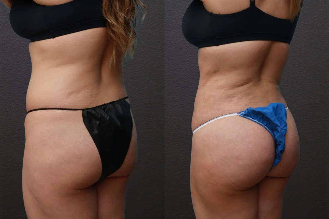 79674-Left Oblique combined