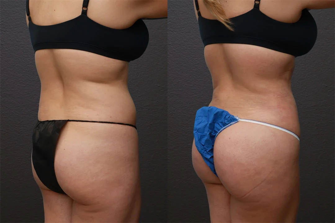 79674-Right Oblique combined