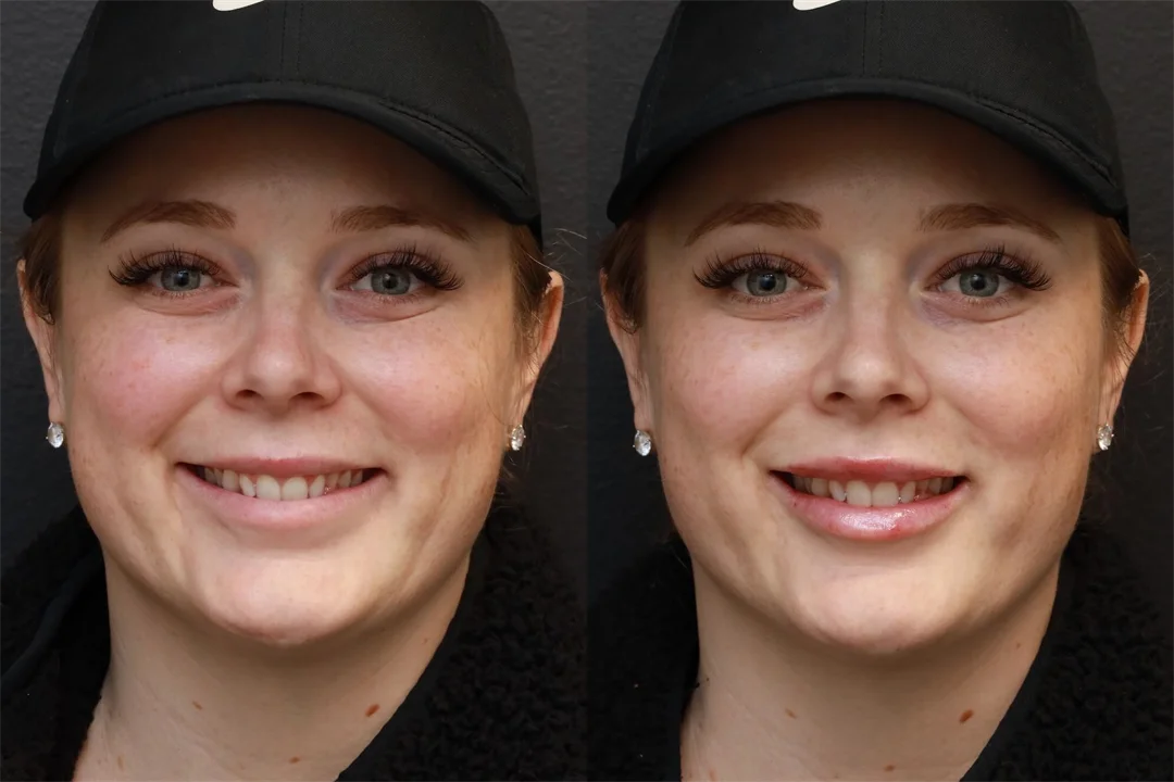 79675-AP Smiling combined