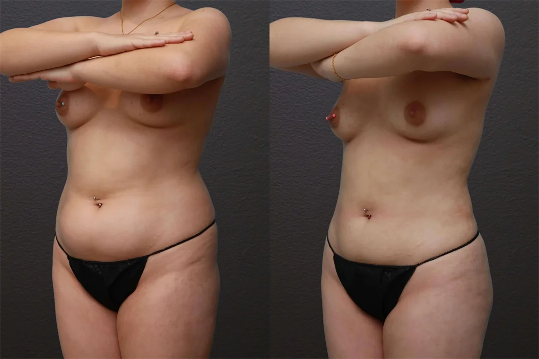 79813-Left Oblique combined