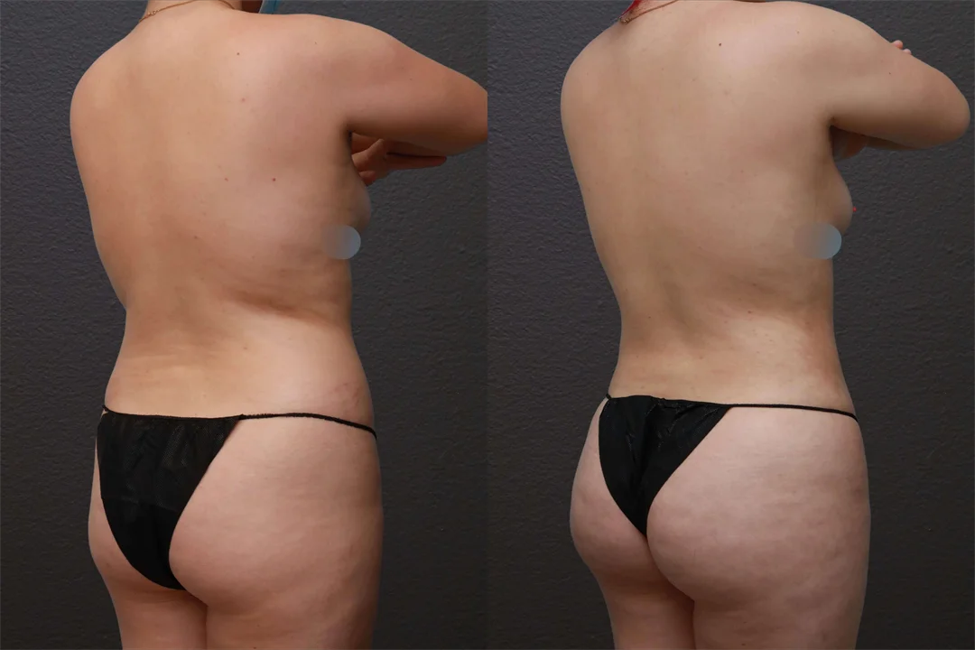 79813-Right Back Oblique combined
