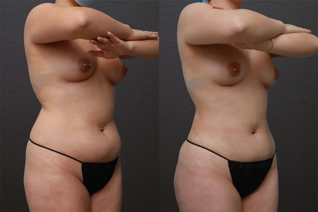 79813-Right Oblique combined