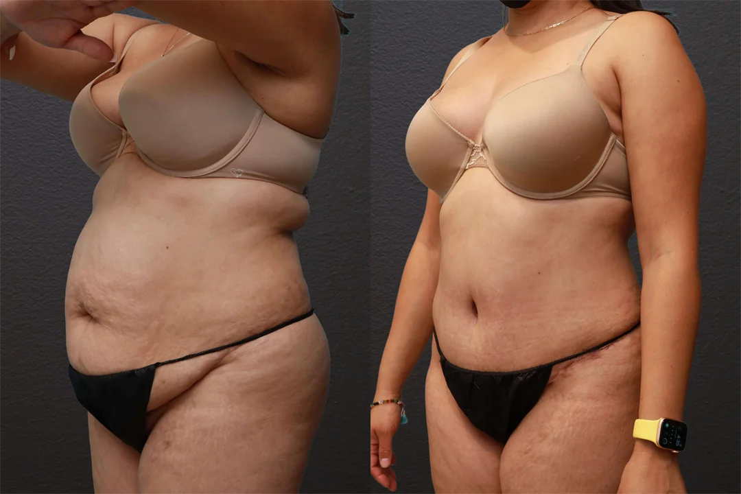 80345-Left Oblique Before