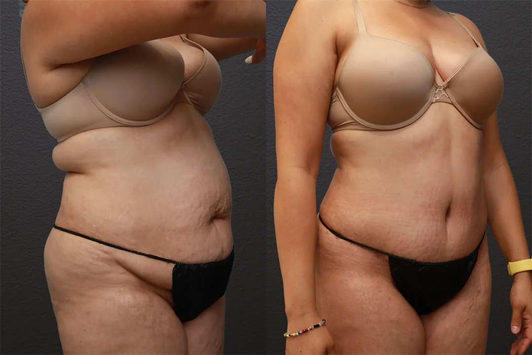 80345-Right Oblique Before