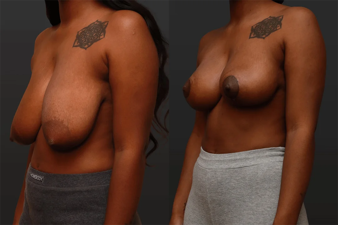 80468-Left Oblique combined