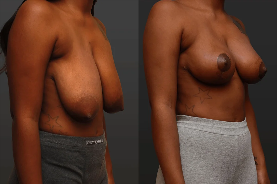 80468-Right Oblique combined