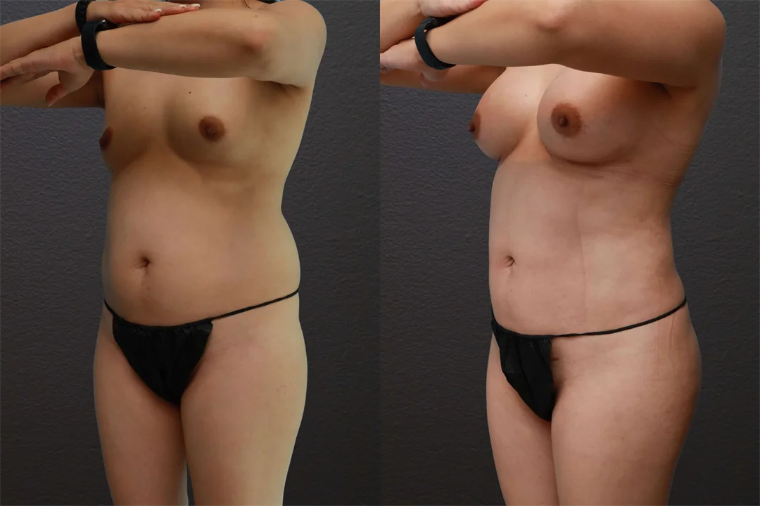 80553-Left Oblique Arms Up combined