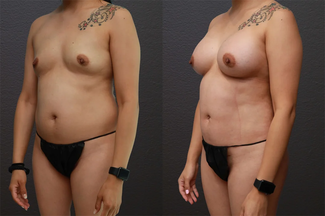 80553-Left Oblique combined