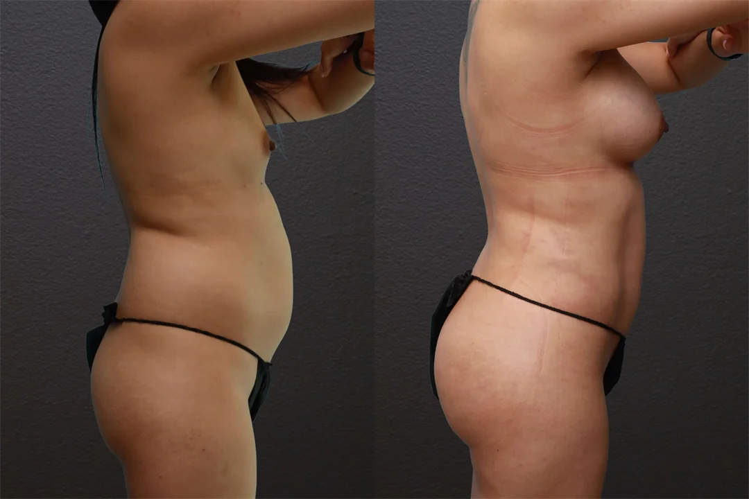 80553-Right Lateral Arms Up combined