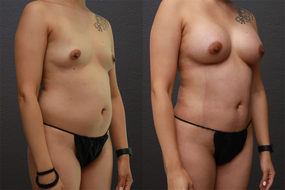 80553-Right Oblique combined
