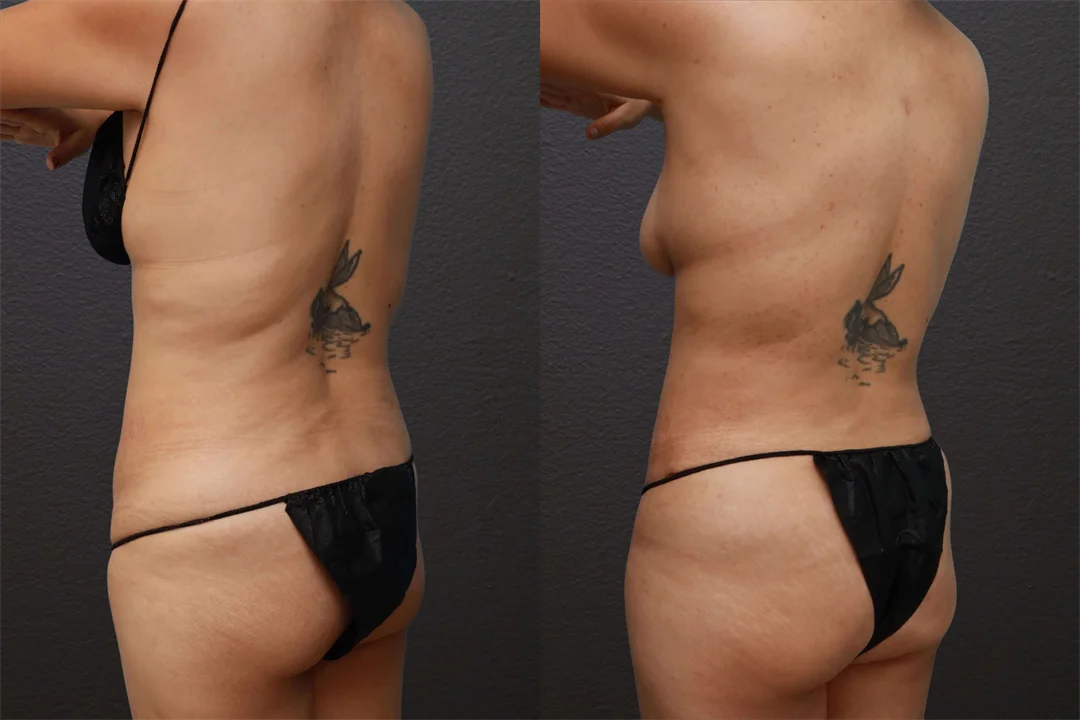 80714-Left Back Oblique Before