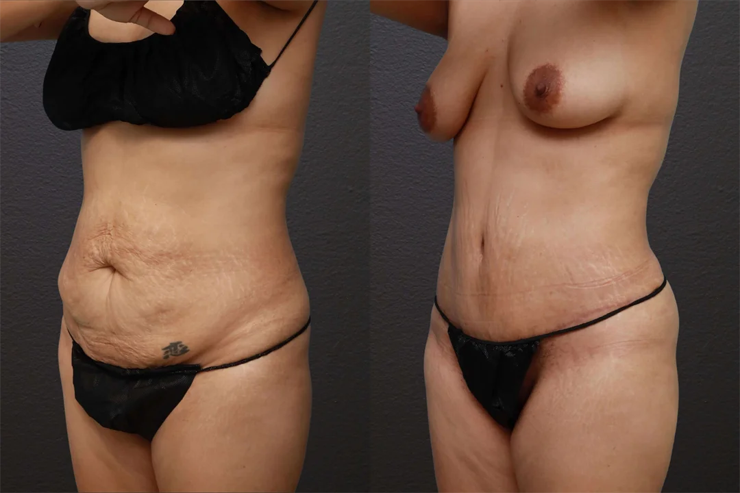 80714-Left Oblique Before