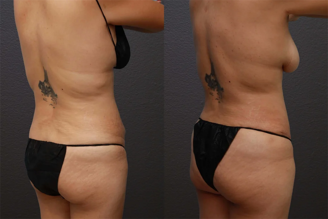 80714-Right Back Oblique Before