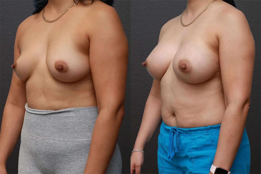80843-Left Oblique combined