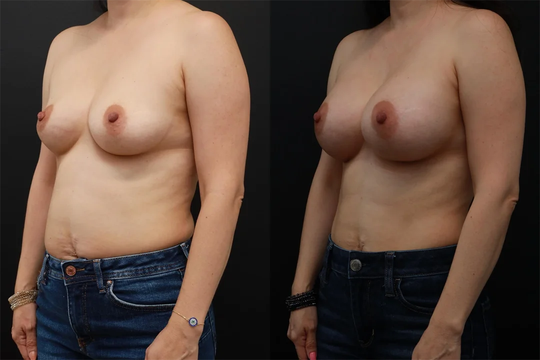 80878-Left Oblique combined