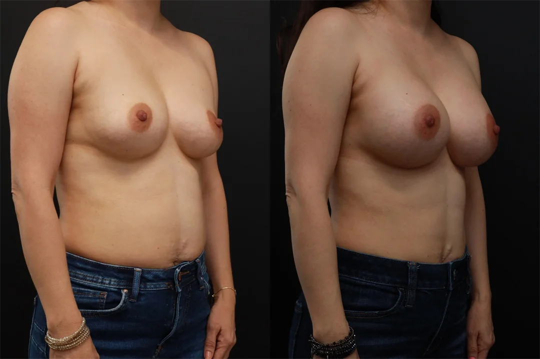 80878-Right Oblique combined