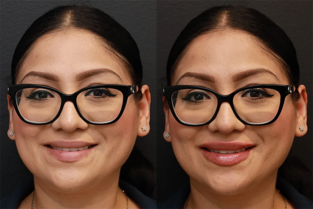 81658-AP Smiling combined