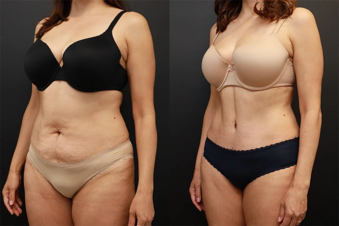 81808-Left Oblique Before