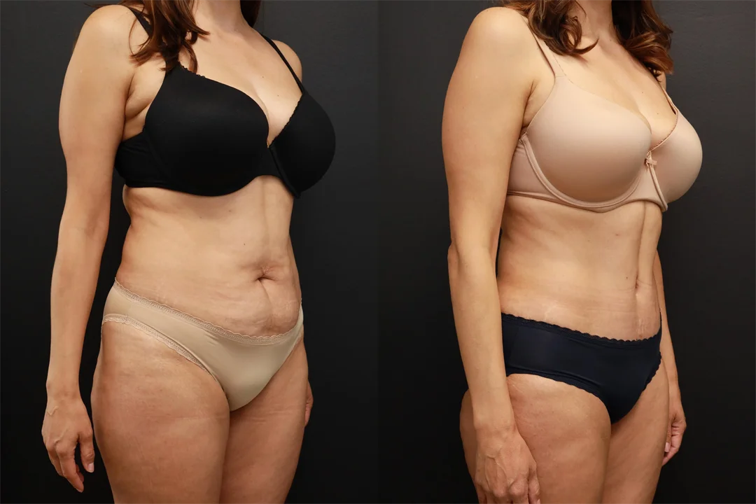 81808-Right Oblique Before