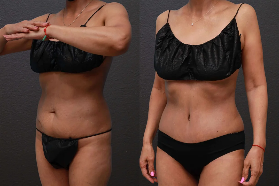 82543-Left Oblique combined