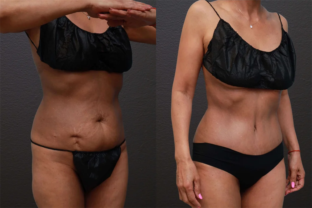 82543-Right Oblique combined