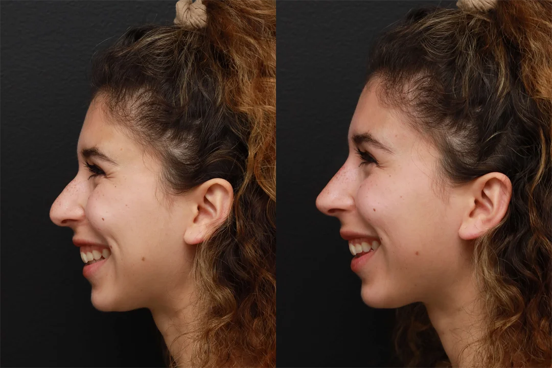 82636-Left Lateral Smiling combined