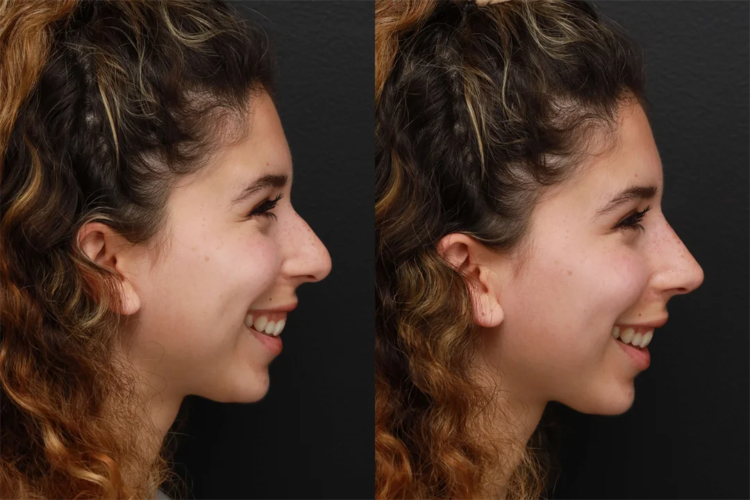 82636-Right Lateral Smiling combined