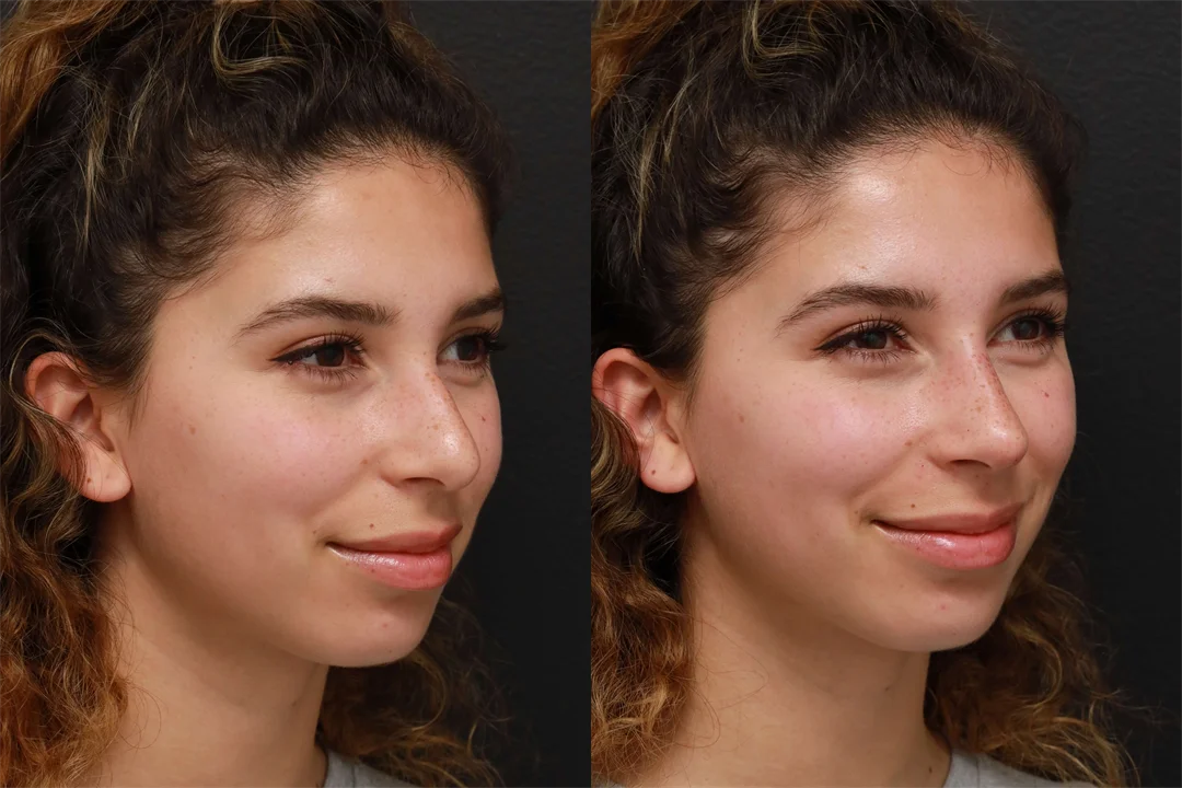 82636-Right Oblique combined