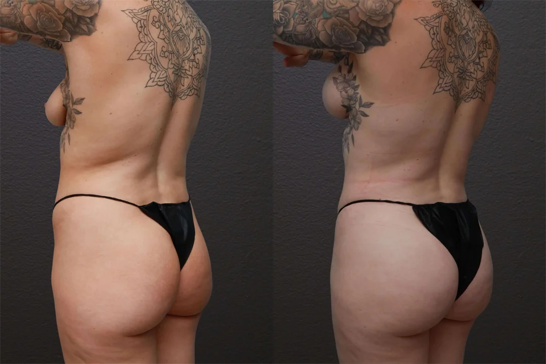 83301-Left Oblique combined