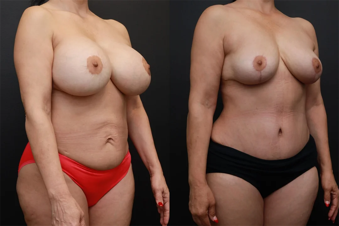 84039-Right Oblique combined