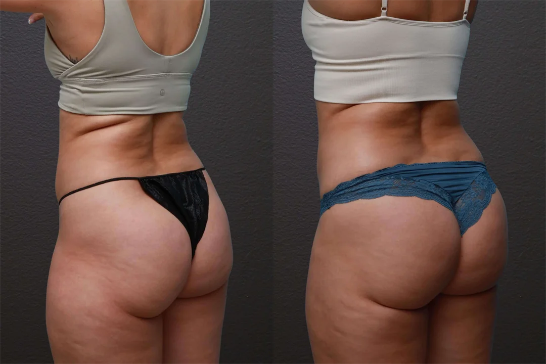 84168-Left Posterior Oblique combined