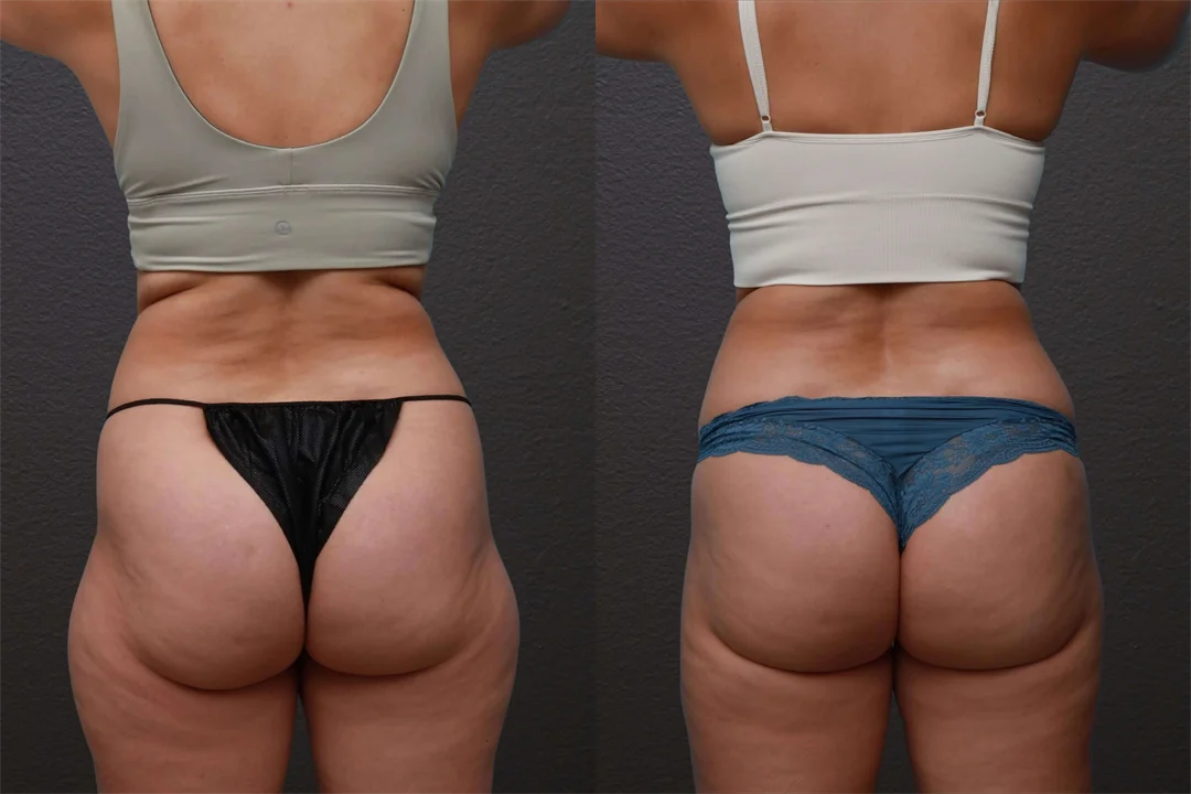 84168-Posterior combined