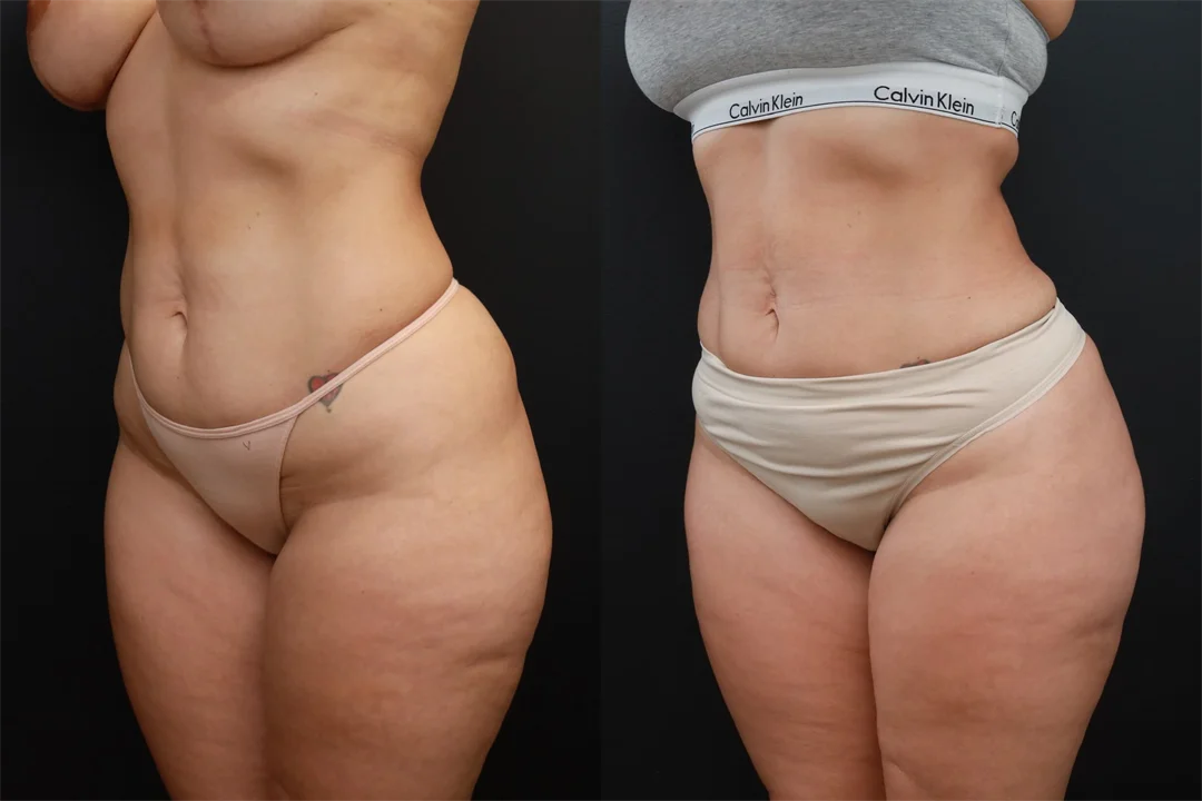 85091-Left Oblique combined