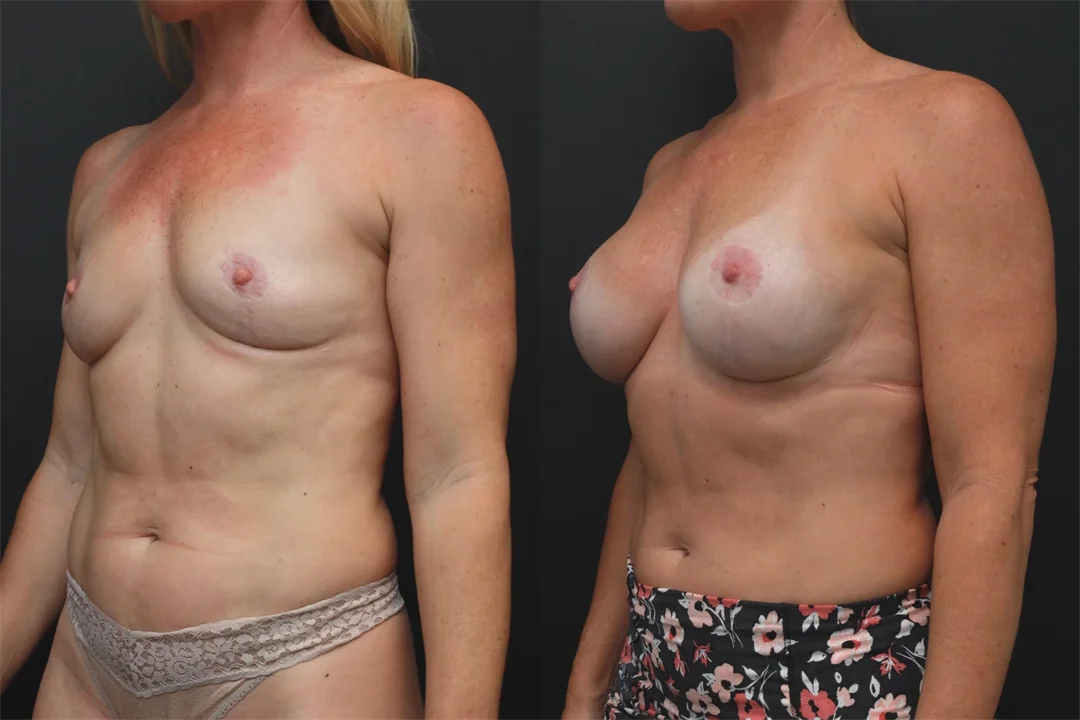 85275-Left Oblique combined