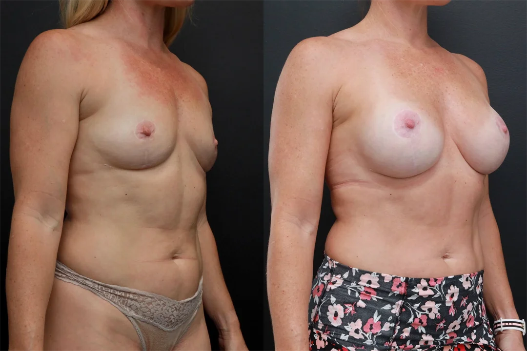 85275-Right Oblique combined