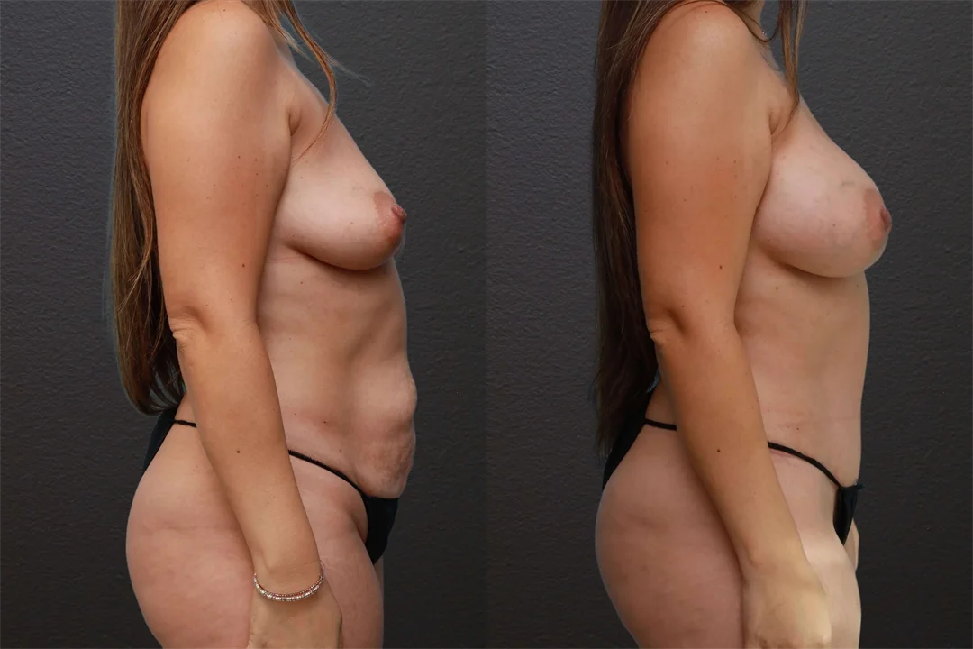 85384-Right Lateral Arms Down Before