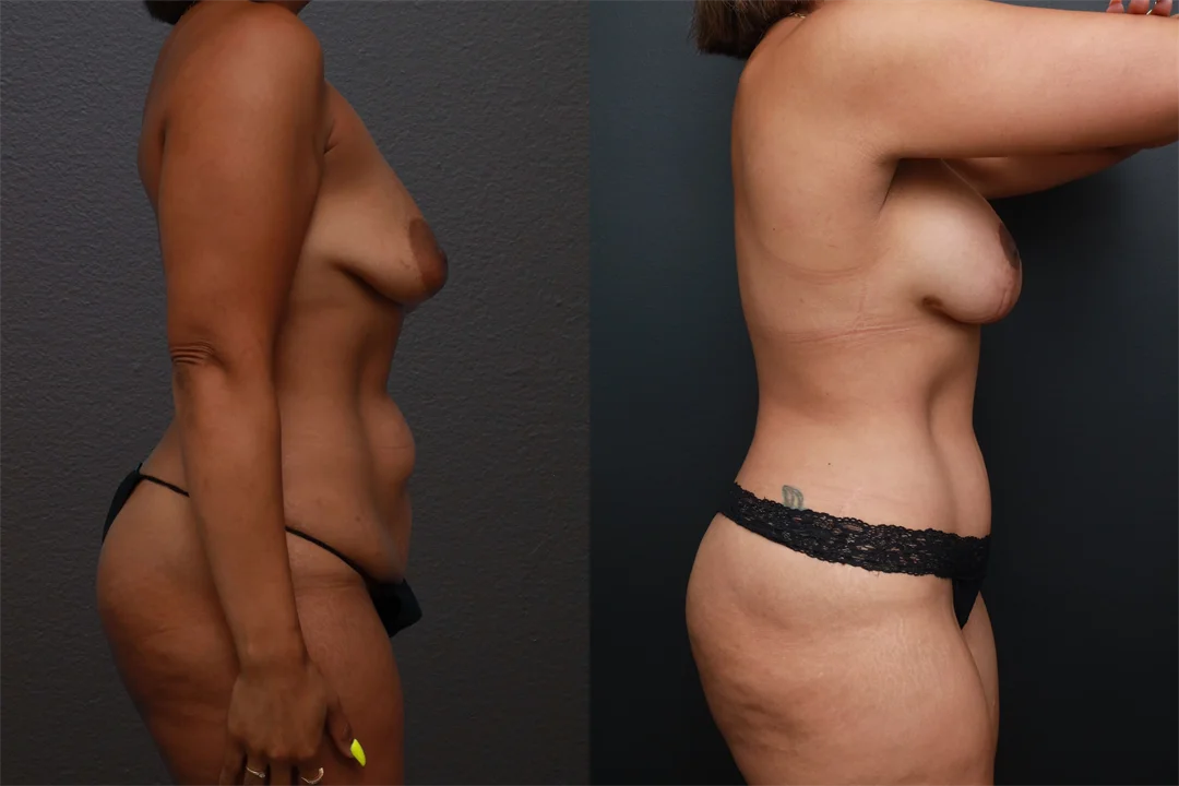 85436-Right Lateral combined
