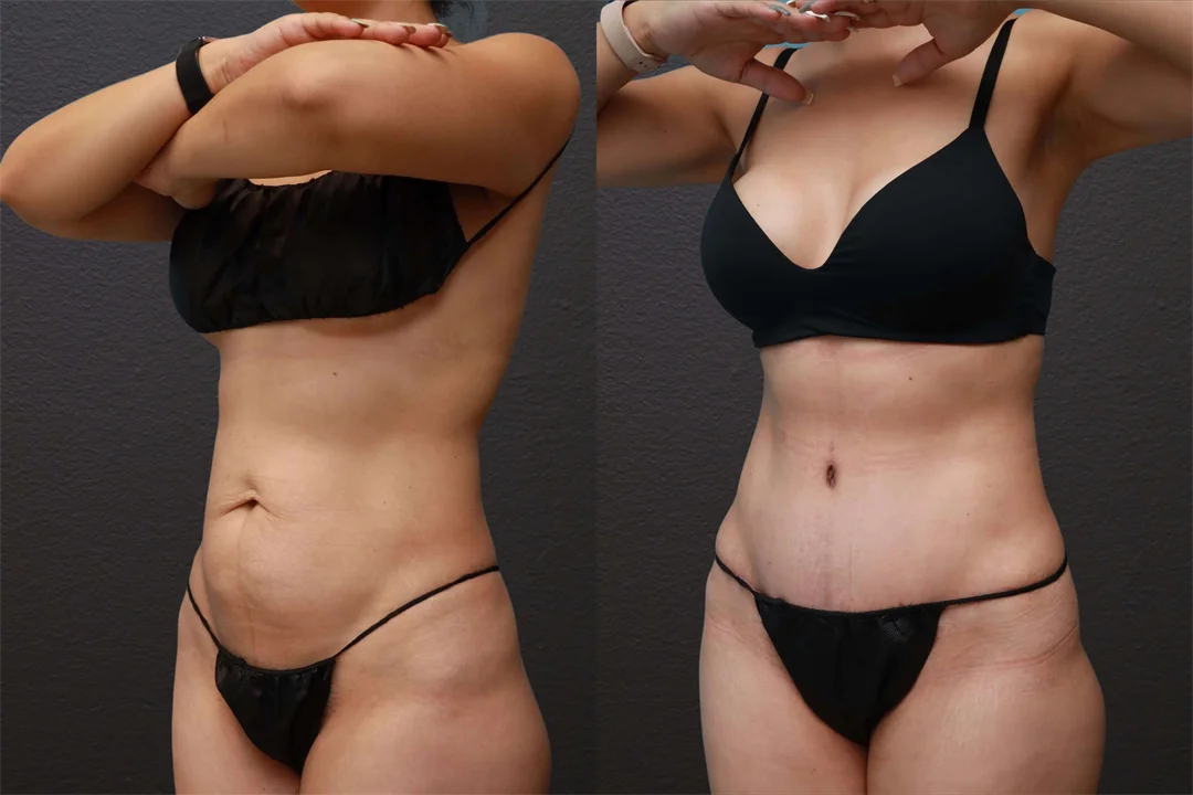 85441-Left Oblique Before