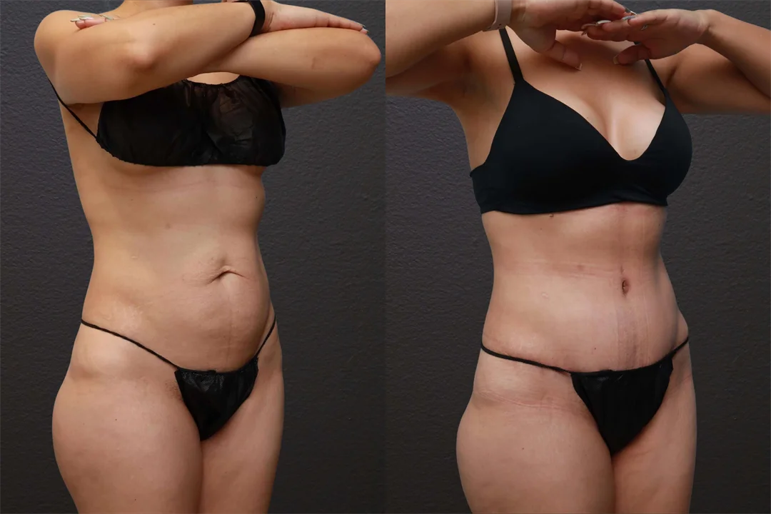 85441-Right Oblique Before