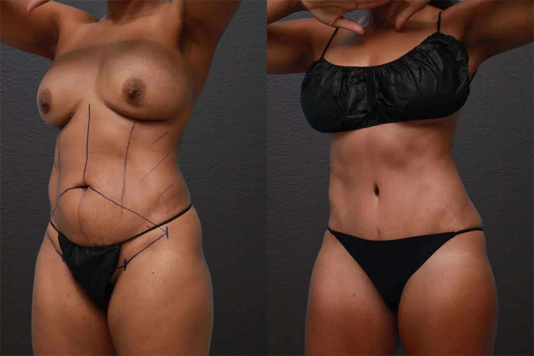 85447-Left Oblique Before