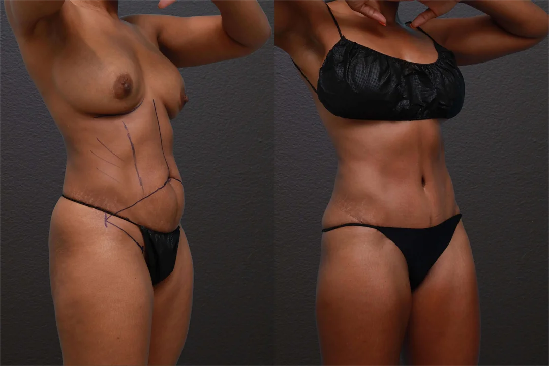 85447-Right Oblique Before