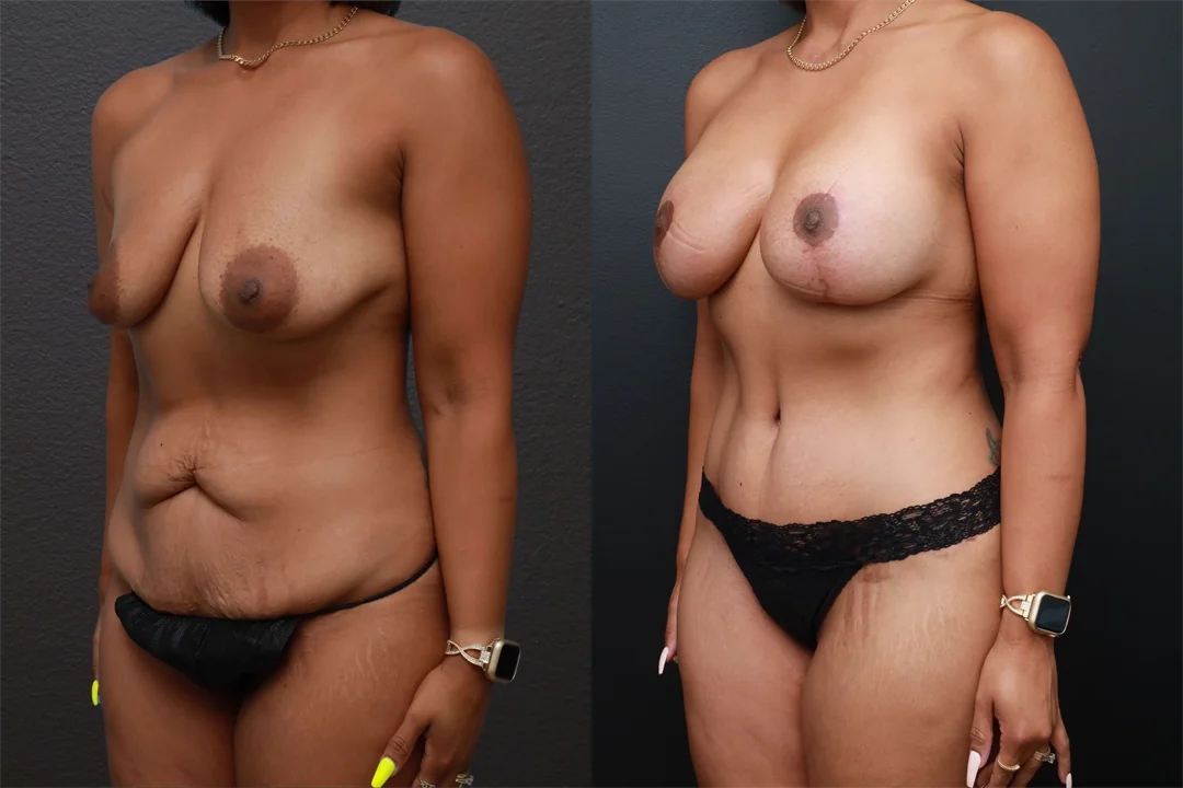 85550-Left Oblique combined