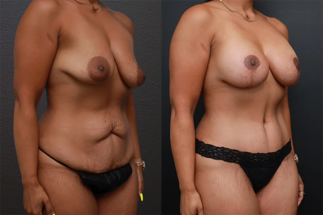 85550-Right Oblique combined
