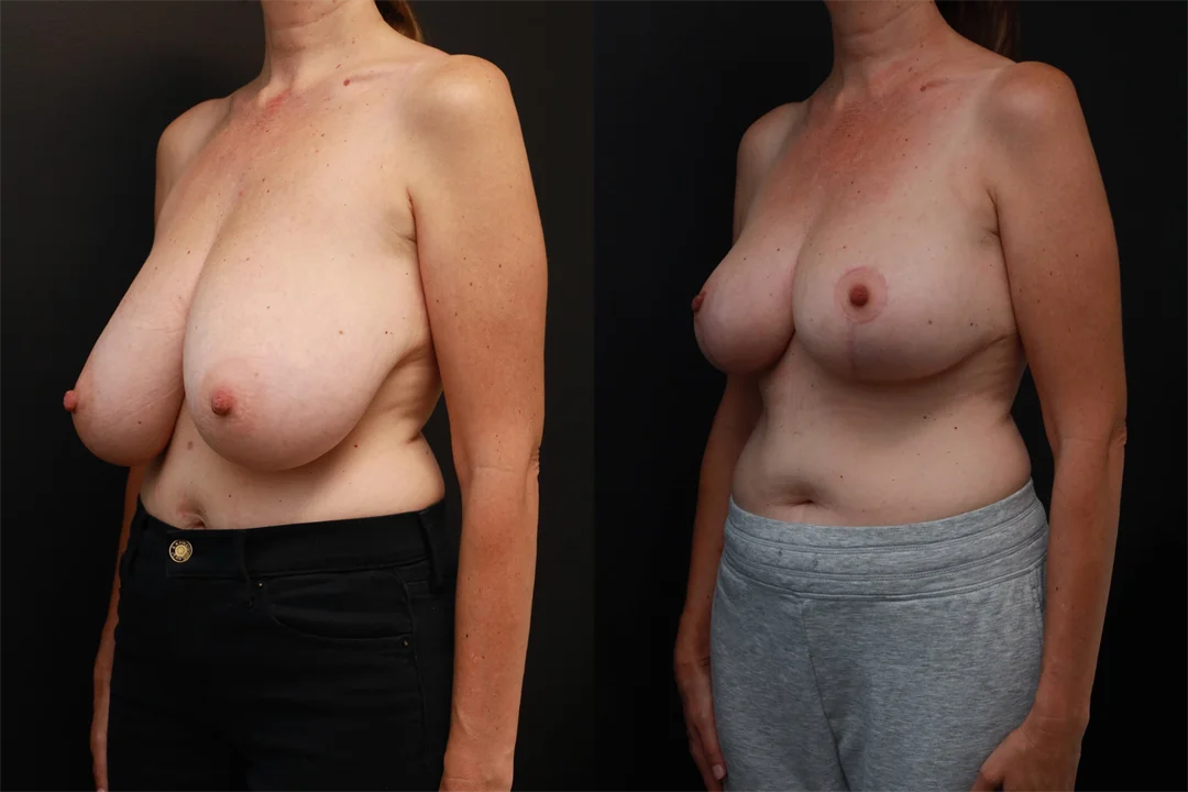 85558-Left Oblique combined