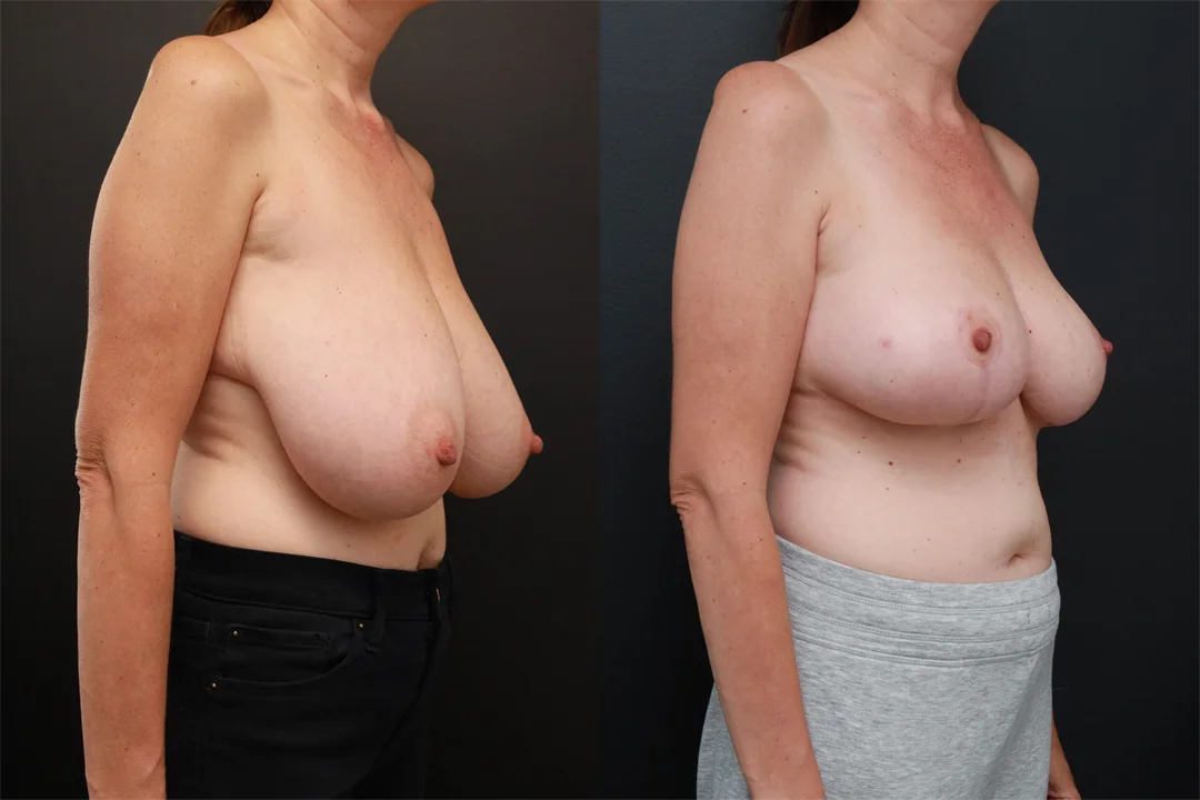 85558-Right Oblique combined