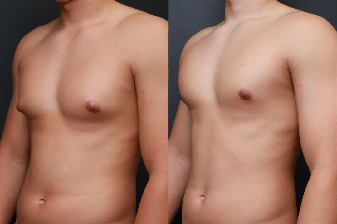 85867-Left Oblique combined