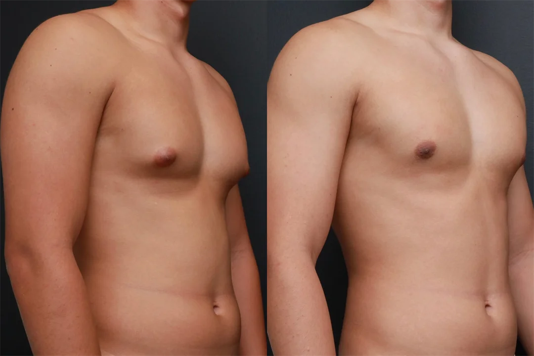 85867-Right Oblique combined