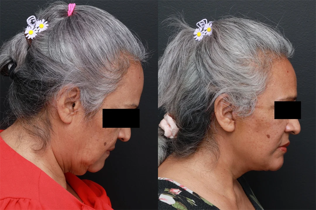 86034-Right Lateral Neck Flexed combined
