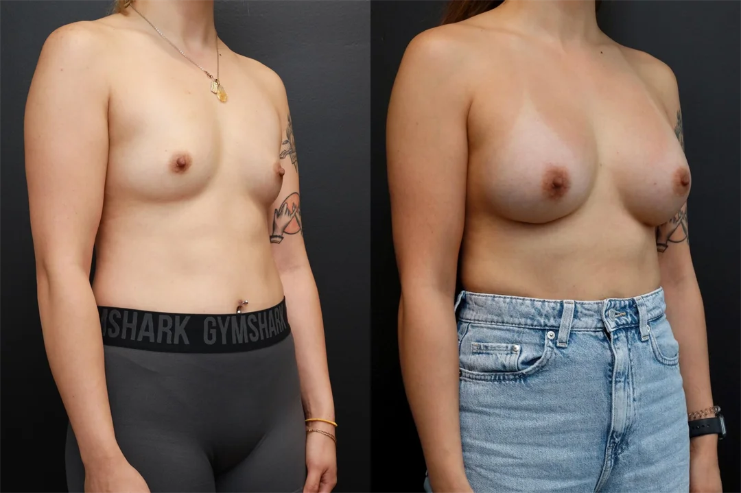 86416-Right Oblique combined