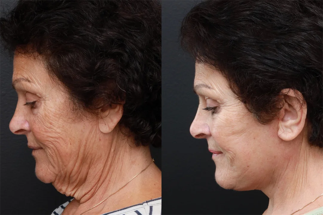 86595-Left Lateral Flexed combined